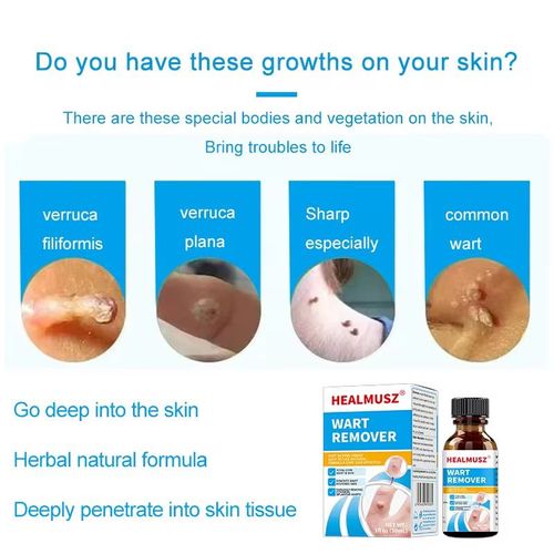 Suitable for various skin warts, Patent formula Ketrodil solution, featuring natural plant extracts, specifically targets flat warts, wart-like growths, and flesh-like horn-like warts. It penetrates deep into the wart base, reducing hyperplasia and improving the skin texture, with a gentle and non-irritating effect. Order today and get 3 bottles, Eliminate warts on the face, hands, and private areas completely, avoiding laser freezing. Enjoy smooth skin at home.