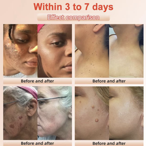 Place your order today and you will receive 5 boxes of the exfoliating and skin-repairing gel that removes melanin and reduces dullness. This refreshing and rejuvenating exfoliating gel can gently remove aging and dead skin cells, deeply cleanse the pores, and add moisturizing ingredients. After use, your skin will not feel tight, allowing you to say goodbye to dullness and roughness and regain a smooth, bright and delicate complexion.