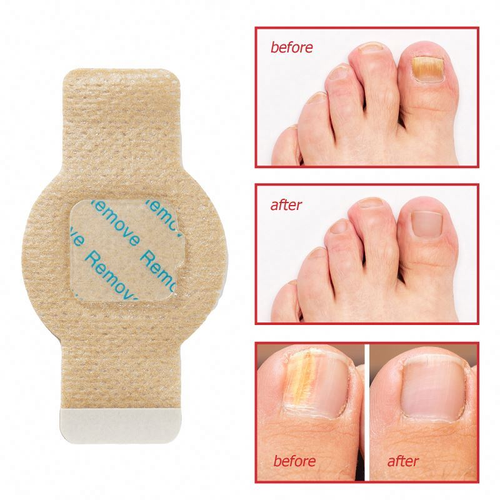 Nighttime Renewal Fungal Nail Treatment Patches Effortless Hydrogel Nail Care 8 Hours Fast Effective Nail Repair Patches  3X21=63Patches