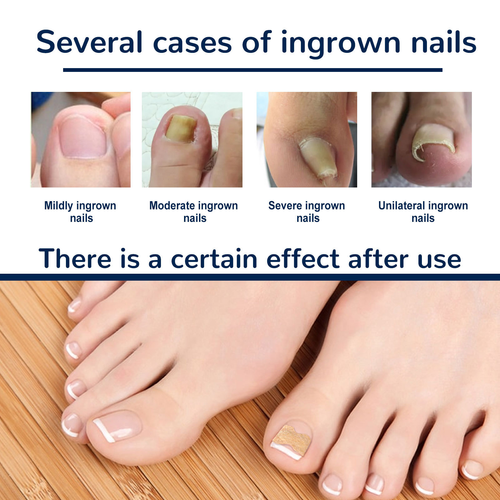 Nail Care: Gentle cleaning and protective patches for soft, ingrown, thickened, or fungal nails.