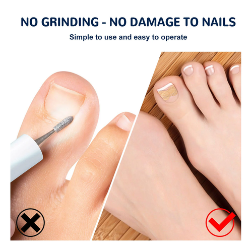 Nail Care: Gentle cleaning and protective patches for soft, ingrown, thickened, or fungal nails.
