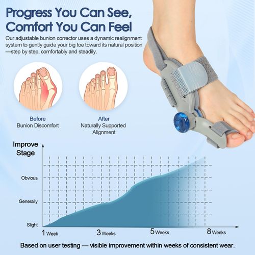 Bunion Corrector for Women Men Big Toe,Adjustable Knob Bunion Corrector for Bunion Relief,Bunion Fix with Bunion Silicone Pad,Suitable for Left and Right Feet(1PCS)
