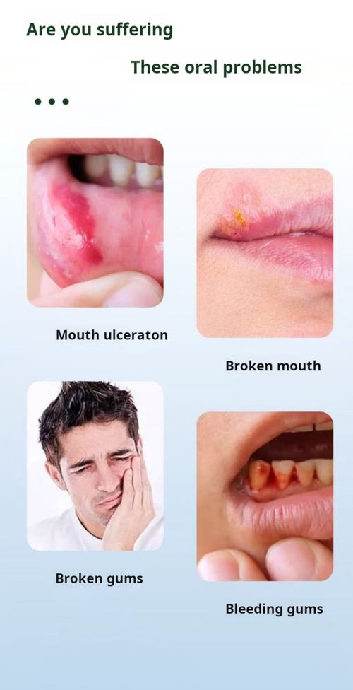 2370--2 Pieces Oral gel ointment