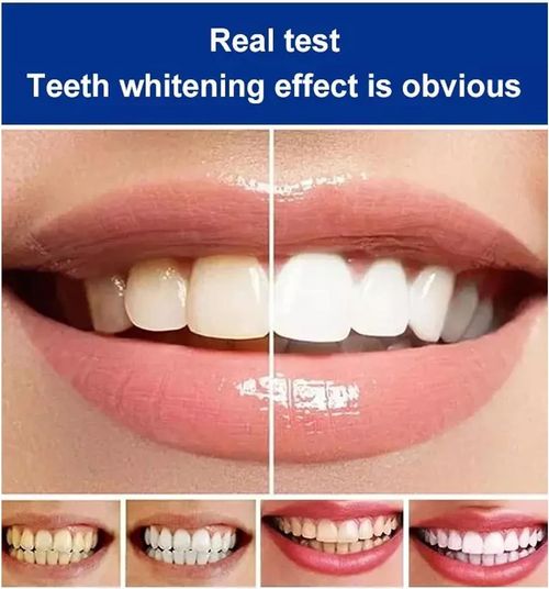 Ultra SP-4 Probiotic Whitening Toothpaste (2pcs,Red)