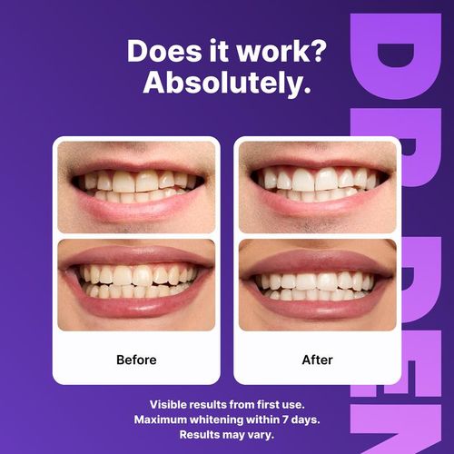 Purple Teeth Whitening Strips Whitening Sessions - Safe for Enamel - Non Sensitive Teeth Whitening  Peroxide-Free