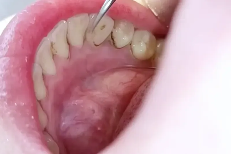 🦷✨Smile Brighter - Pro Ultrasonic Teeth Cleaner with Multi-Speed Control🦷✨