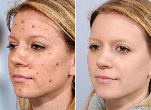 TagRecede Bee Venom Treatment Spray