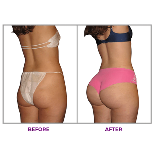 Buy1 Get 1 Free（2PCS）Hip Plump Capric Oil D01