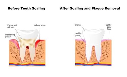 Toothpaste Mousse Foam, Calculus Removal, Teeth Whitening, Healing Mouth Ulcers, Eliminating Bad Breath, Preventing and Healing Caries, Tooth Regeneration