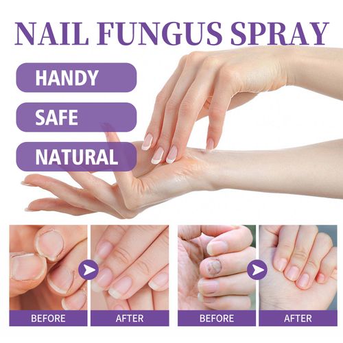 Medical Grade Jaysuing Fingernail & Toenail Care Spray, Soften Clean Repair Yellowing, Thickened and Ingrown Nails