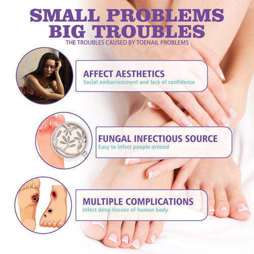 Medical Grade Jaysuing Fingernail & Toenail Care Spray, Soften Clean Repair Yellowing, Thickened and Ingrown Nails