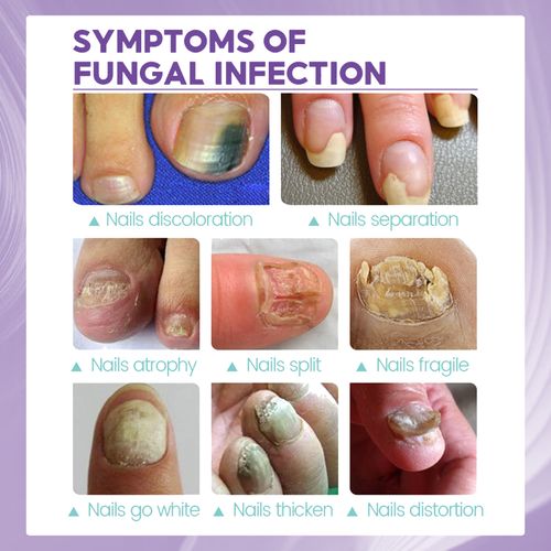 Medical Grade Jaysuing Fingernail & Toenail Care Spray, Soften Clean Repair Yellowing, Thickened and Ingrown Nails