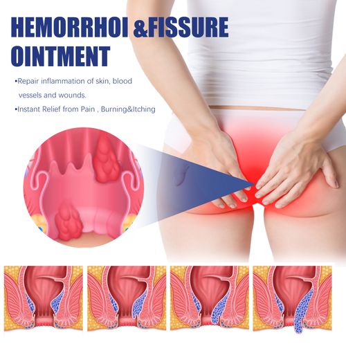 Hemorrhoid ointment for reducing swelling, itching, and pain in the anal area caused by mixed internal and external meatballs. Anal Comfort Care Cream