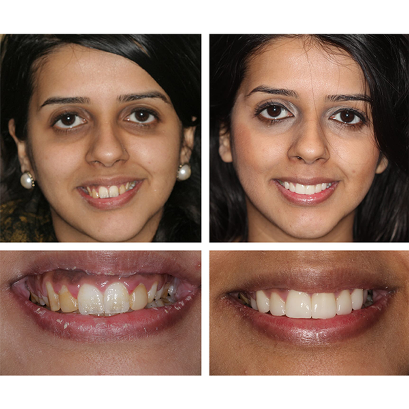 🔥Last Day 49% OFF Teeth Whitening Essence