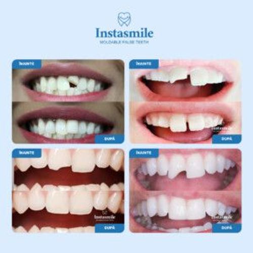 牙齿修复颗粒 INSTASMILE – quick smile restoration for broken, missing or spaced teeth