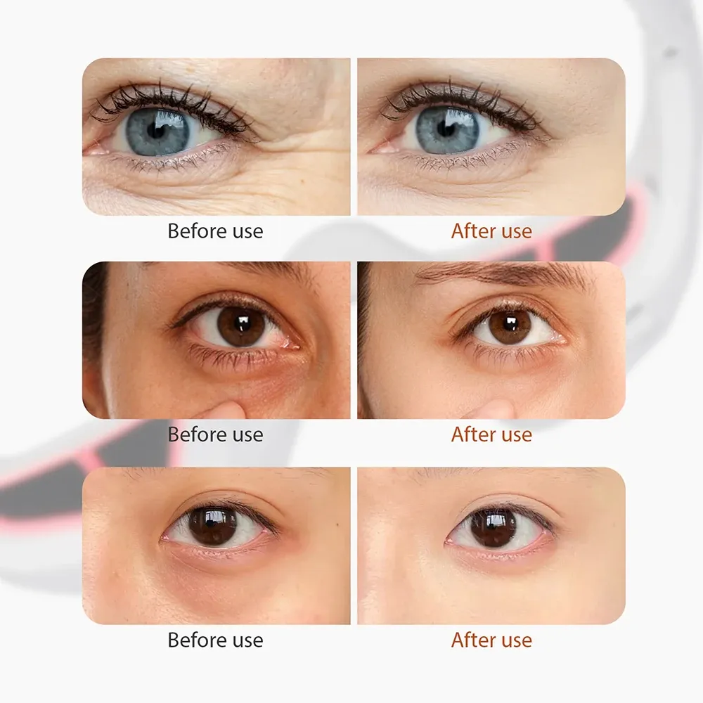 Professional EMS Eye Therapy - Dark Circles & Wrinkles Vanish in Minutes.