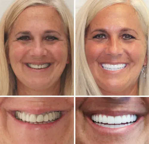 Haute Couture Full Denture Set