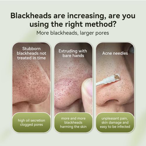 LANBENA Blackheads & Whiteheads Removal Kit for Clear, Radiant Skin: Facial Exfoliating Power, Acne Deep Cleansing, 30g Clay Mask, and Nasal Strips for a Fresh-Faced Glow! Skincare