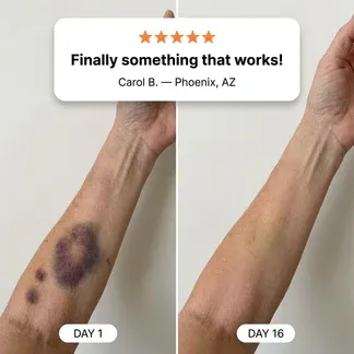 💥200K+ SOLD💕- LIMETOW® Bruise Repair & Skin-Strengthening Cream|Buy 1 Free 1