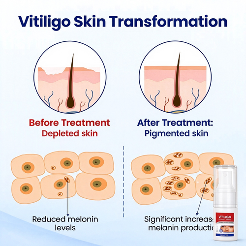 VITILIGO™ Vitiligo Treatment Spray,Buy 1 Get Free 1