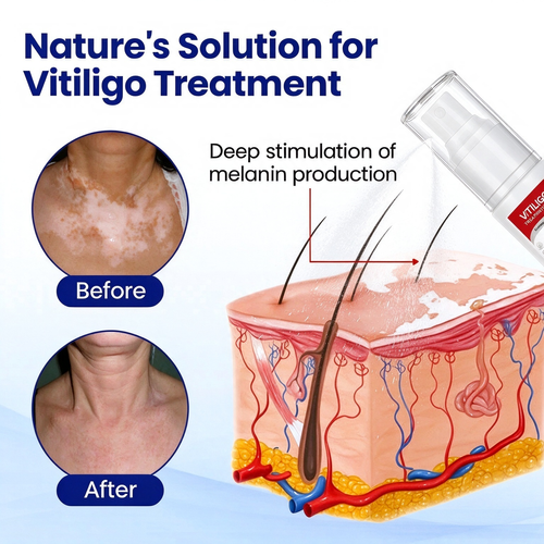 VITILIGO™ Vitiligo Treatment Spray,Buy 1 Get Free 1