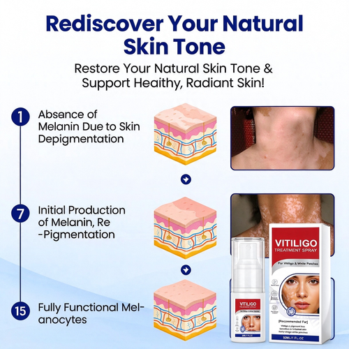 VITILIGO™ Vitiligo Treatment Spray,Buy 1 Get Free 1