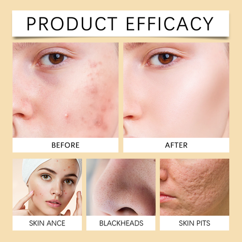 Most Popular Korean Skincare Turmeric Kojic Acid Anti Acne Whitening Foaming Skin Face Cleans Facial Foam Cleanser with Brush