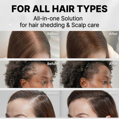 Korean ADVANCED SCALP CARE Prevents Hair Loss and Promotes Hair Growth Hair Care Serum Brush for Hair Scalp Care