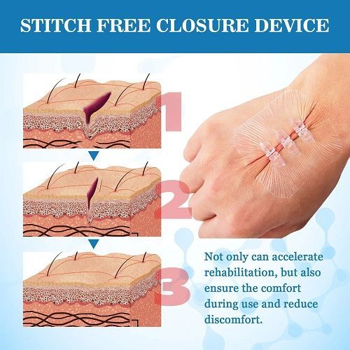 1Pcs Portable Wound Closure Patch Painless Suture Zipper Band-Aid Repair Wounds Waterproof Stitch Free Hemostatic Sticker