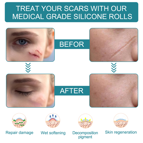 Categoria médica silicone acne remoção cicatriz patch reparação C seção cicatriz de silicone patch