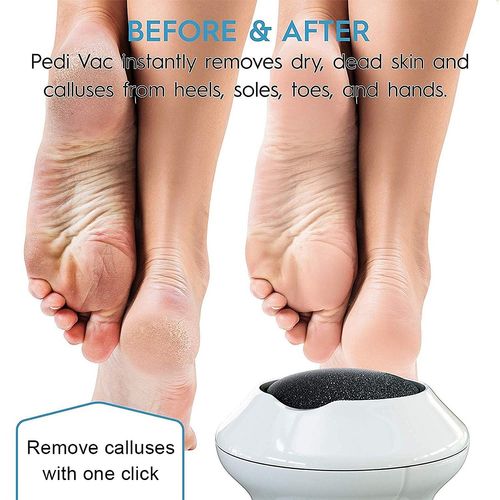 Rechargeable Electric Foot Callus Remover, Foot Grinder Pedicure Tool For Dead & Hard Cracked Dry Skin (Foot File)