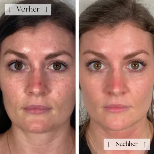 💖FVRLLY LED Contour Mask | Perfect skin within ✨30 days✨