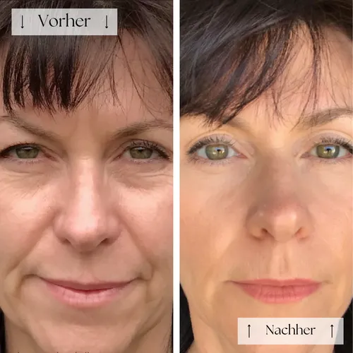 💖FVRLLY LED Contour Mask | Perfect skin within ✨30 days✨