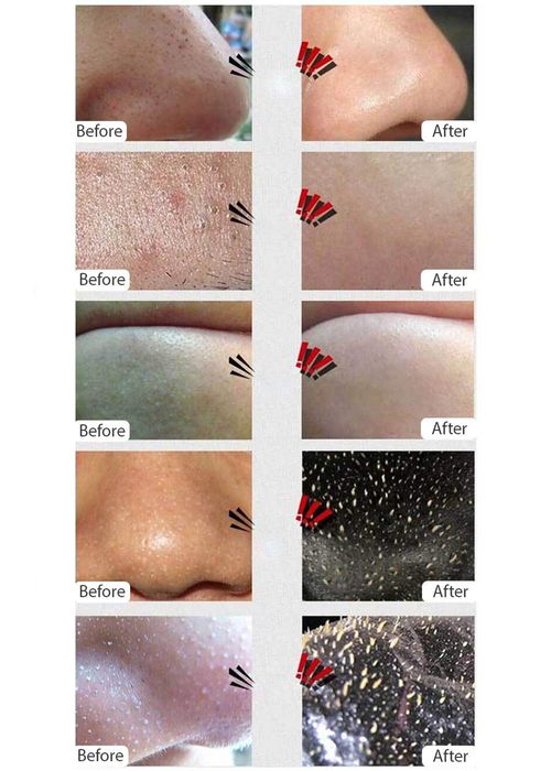 Aichun Beauty Black Facial Mask Brighteens Complex + Free Black Head