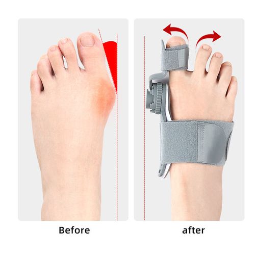 Knob-Type Hallux Valgus Corrector, Unisex for Adults