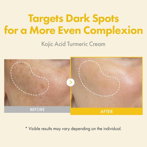 Kojic  Acid Turmeric cream 2-packs