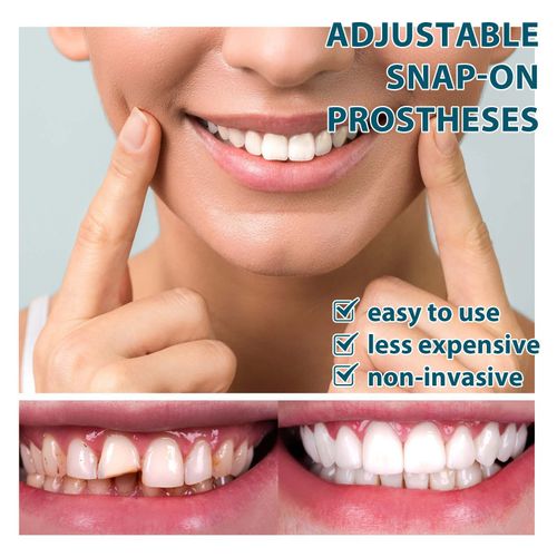 Adjustable denture set, perfect fit, whitens teeth, snap-on silicone portable denture aligner, fills gaps between teeth, smile veneers.