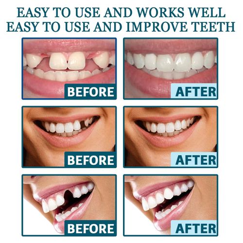 Adjustable denture set, perfect fit, whitens teeth, snap-on silicone portable denture aligner, fills gaps between teeth, smile veneers.
