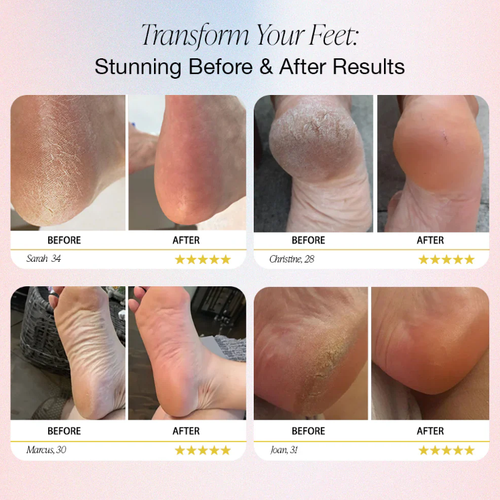 💥Limited-time offer: 49% OFF🔥⚡Electric callus remover for feet