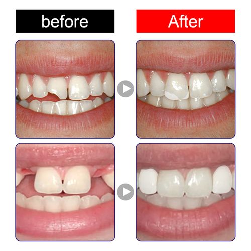 Moldable False Teeth Thermal Beads, Temporary Tooth Repair Material for Cosmetic Smile Decoration