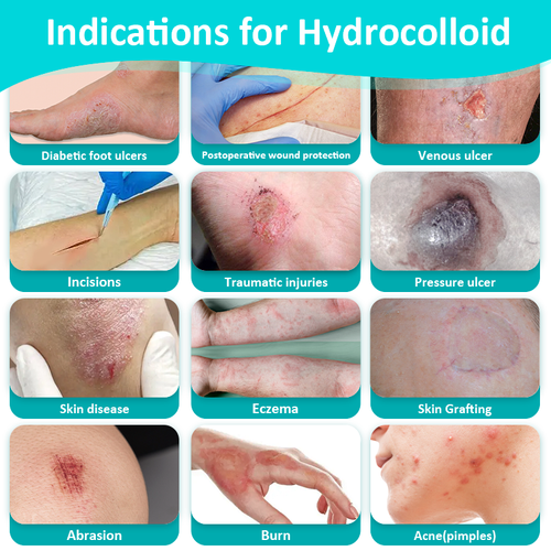 Flexible Hydrocolloid Roll Dressing Disposable Moist Healing Waterproof Skin-Friendly Wound Care