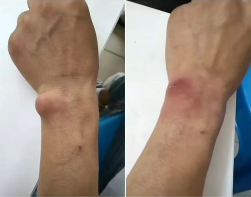 中医技术调理手部囊肿 腱鞘囊肿 Hand cyst   ganglion