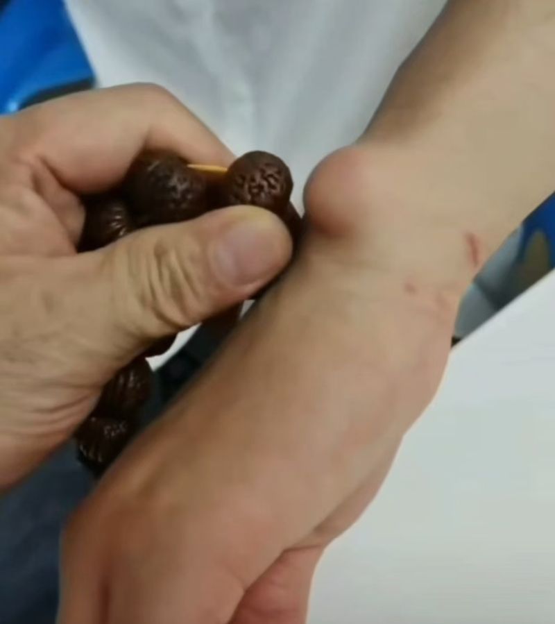 中医技术调理手部囊肿 腱鞘囊肿 Hand cyst   ganglion