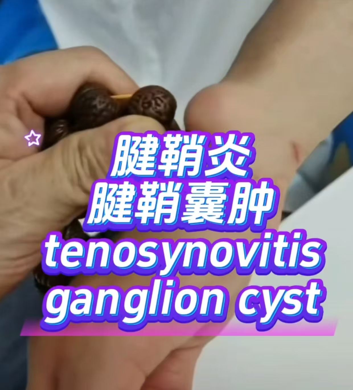 中医技术调理手部囊肿 腱鞘囊肿 Hand cyst   ganglion