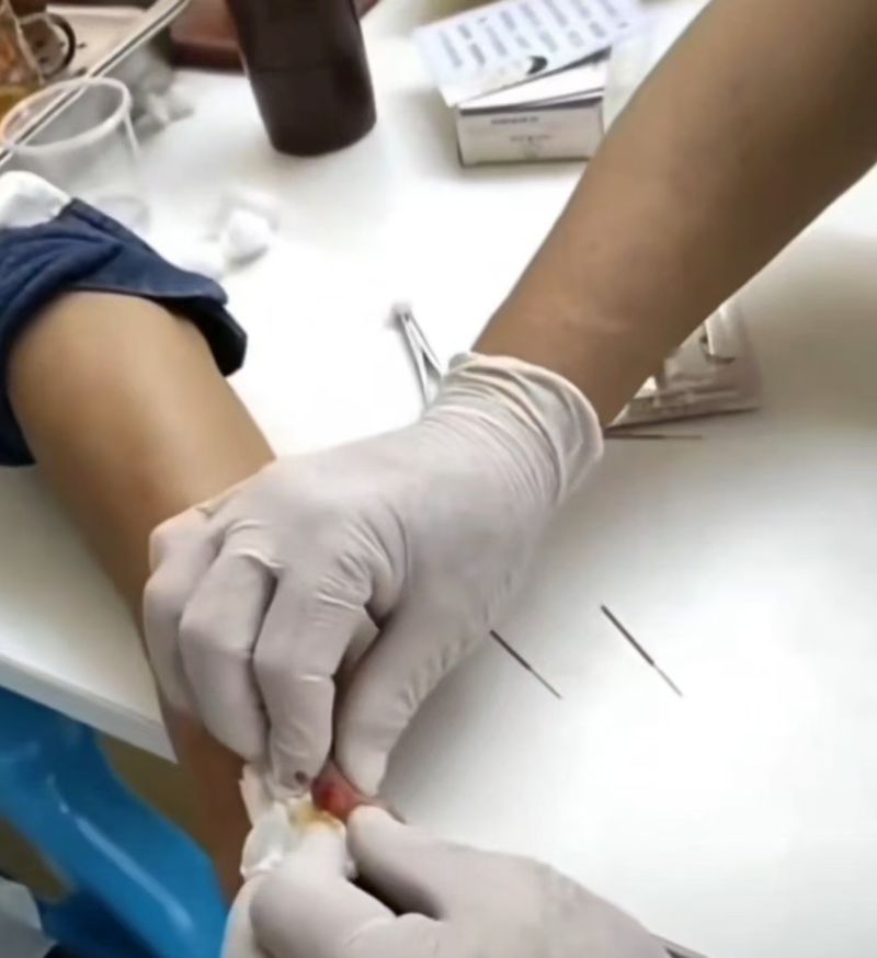 中医技术调理手部囊肿 腱鞘囊肿 Hand cyst   ganglion