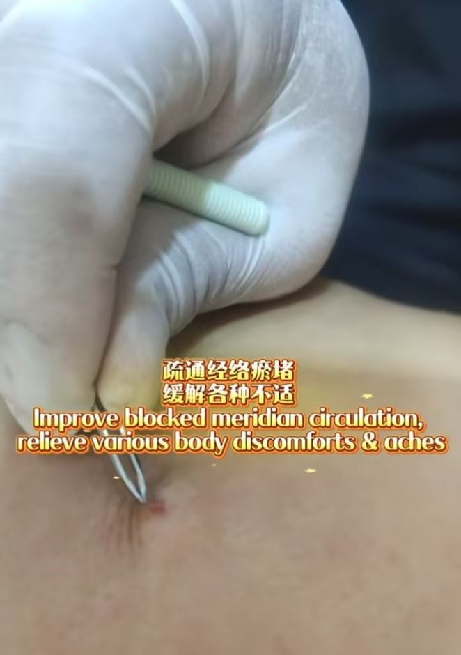 中医技术   疏通经络淤堵   缓解各种酸胀不适Traditional Chinese Medicine Techniques for Clearing Meridian Blockages and Relieving Various Symptoms and Discomfort