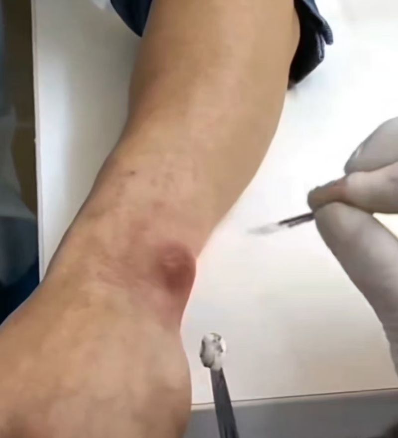 中医技术调理手部囊肿 腱鞘囊肿 Hand cyst   ganglion