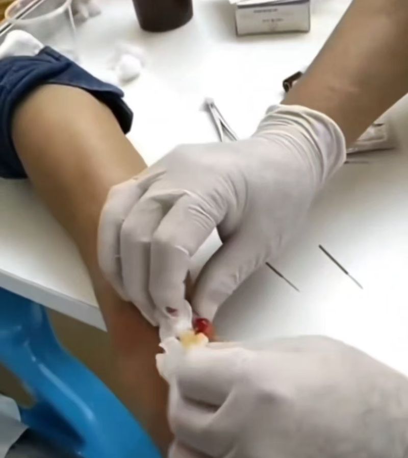 中医技术调理手部囊肿 腱鞘囊肿 Hand cyst   ganglion