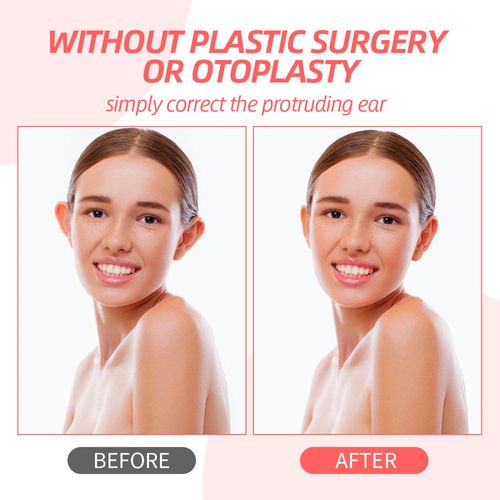 Cosmetic Discreet Protruding Ear Aesthetic Corrector Ear Care Products for Ear Pinning Without Surgery