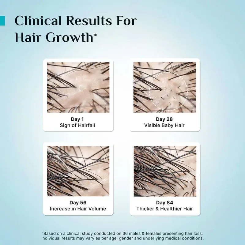 3% Redensyl, 4% Anagain & 5% Capilia Stem Cell Complex Advanced Hair Growth Serum(Buy One, Get One Free)